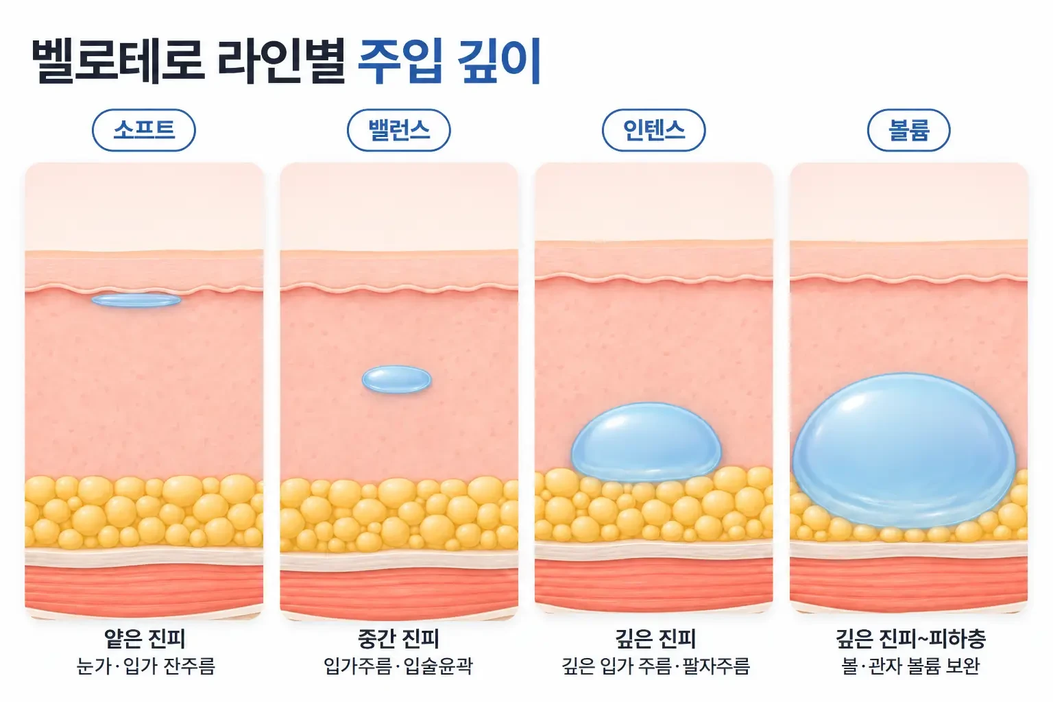 소프트, 밸런스, 인텐스, 볼륨 라인의 주입 층위를 진피와 피하층 깊이별로 비교한 단면도