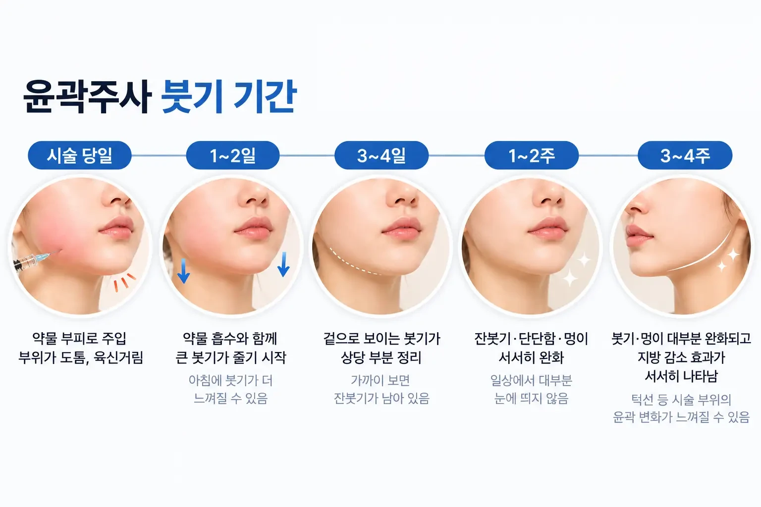 시술 당일, 1~2일, 3~4일, 1~2주 시점별로 윤곽주사 붓기 변화를 정리한 타임라인 이미지