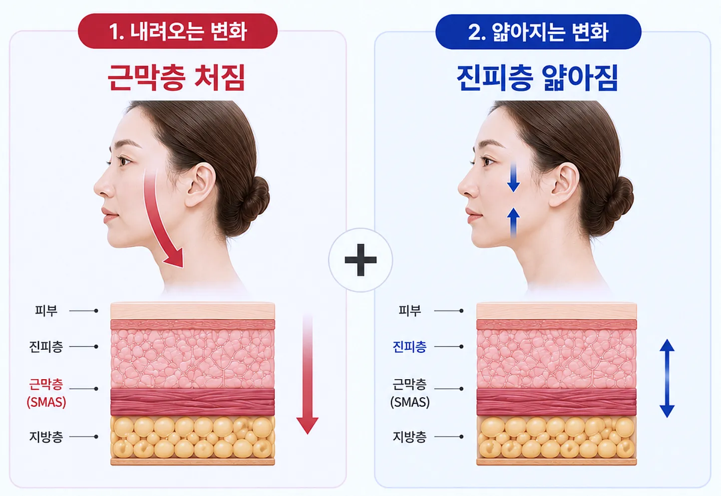 얼굴 노화의 두 방향 - 근막층 처짐과 진피층 얇아짐