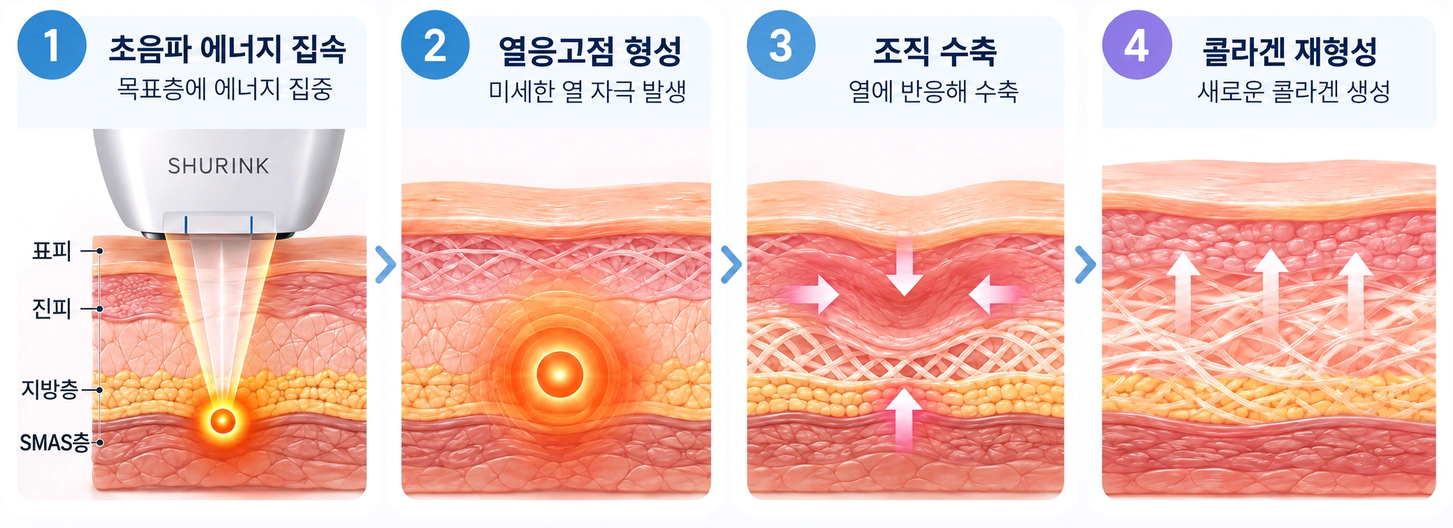 슈링크 초음파 에너지 집속부터 열응고점 형성, 조직 수축, 콜라겐 재형성까지 4단계로 나타낸 피부 단면도
