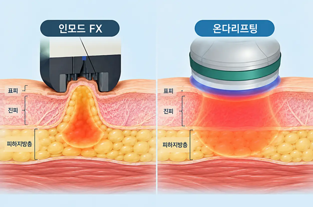 턱밑살 생기는 이유에 따른 지방형 시술 비교 이미지, 인모드 FX 고주파·전기 자극과 온다리프팅 극초단파 에너지가 진피 및 피하지방층에 작용하는 원리 단면도
