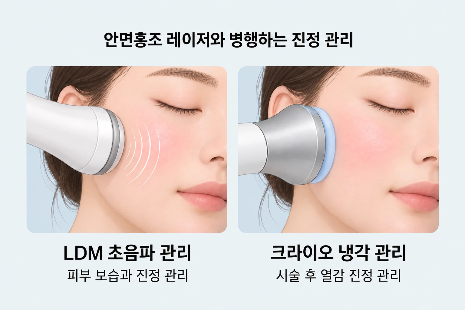 안면홍조 레이저와 병행하는 LDM 초음파 관리와 냉각 진정 관리