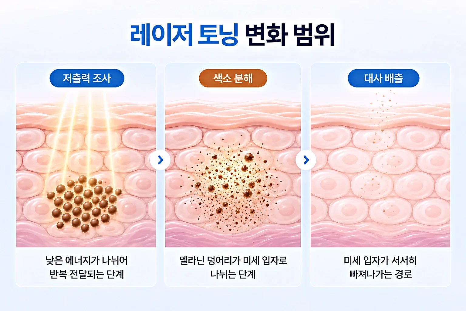 저출력 레이저 조사, 멜라닌 분해, 대사 배출 과정을 동일 배율로 단계별 비교한 개념도