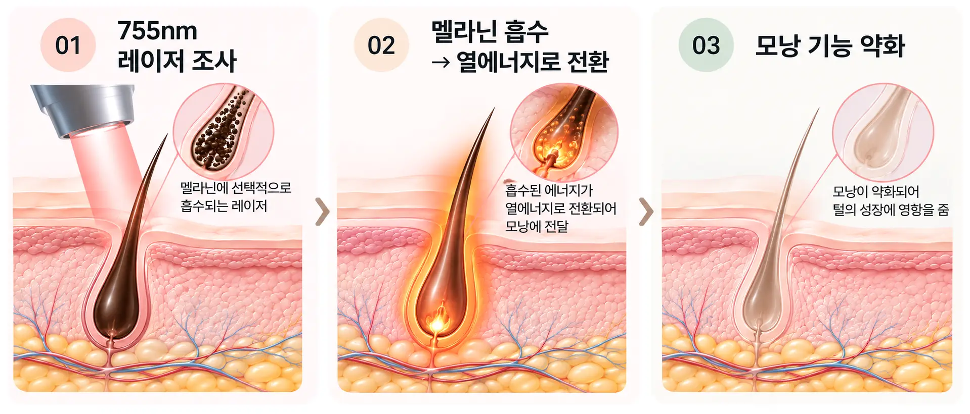 멜라닌에 흡수된 에너지가 모낭에 작용하는 레이저 제모 원리