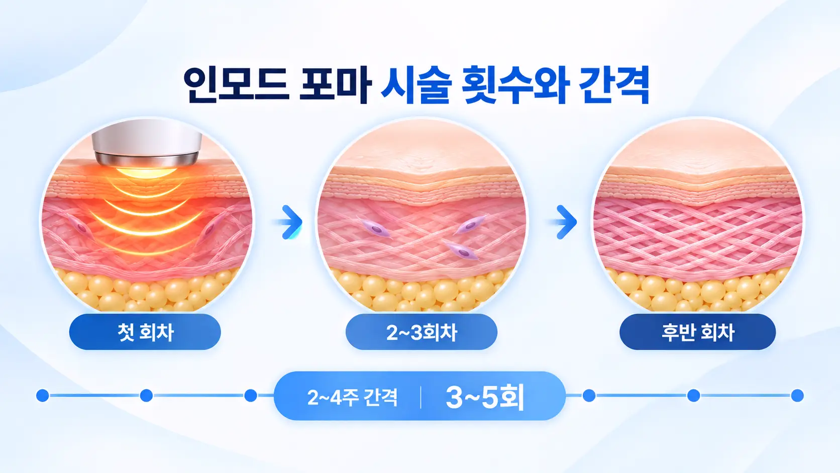 인모드 포마 시술 횟수와 2~4주 간격, 3~5회 시술 과정을 보여주는 피부 단면 일러스트
