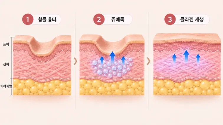 쥬베룩이 여드름흉터 진피층에서 콜라겐 생성을 유도하는 원리 도식