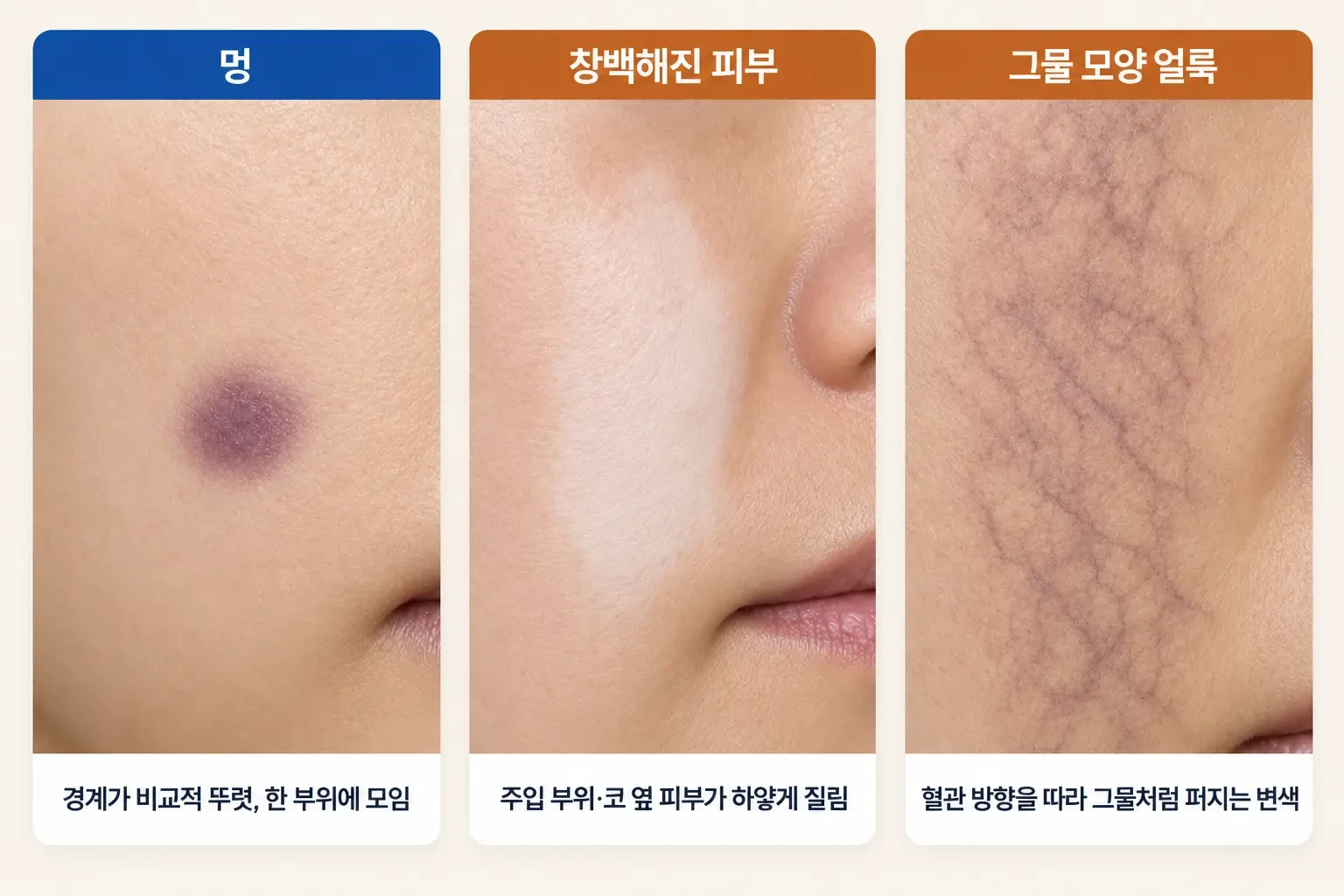 필러 후 한곳에 모인 보랏빛 멍, 창백해진 피부, 그물 모양 얼룩을 비교한 피부 표면 사진