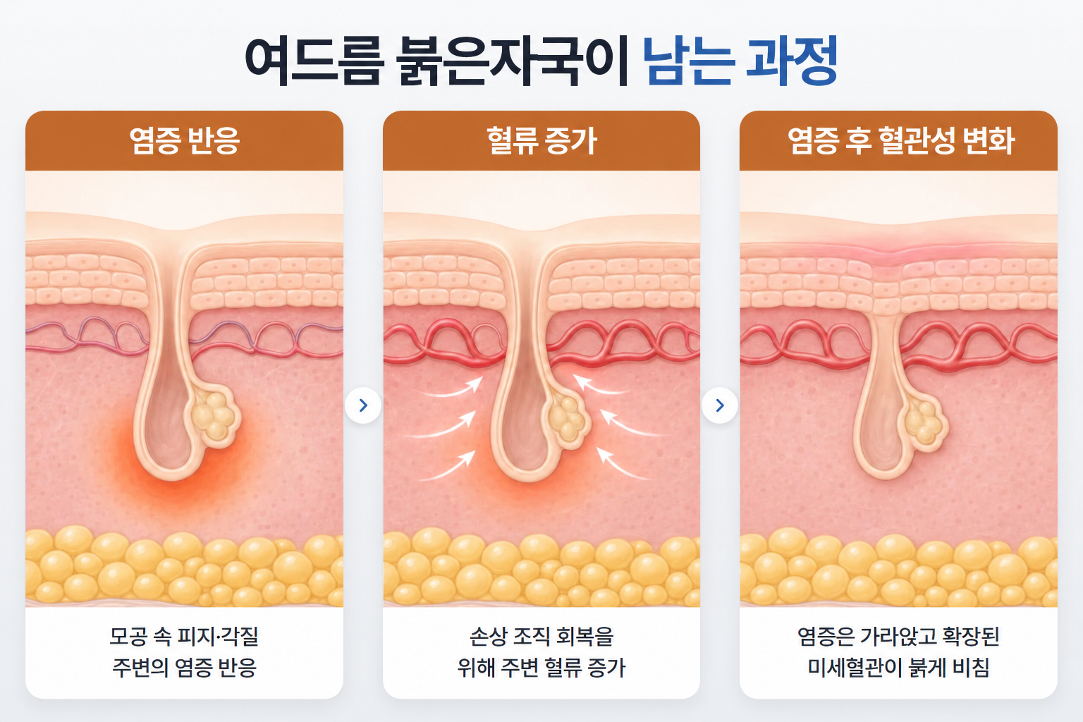 여드름 염증 반응으로 피부 속 혈류가 증가하고 염증이 가라앉은 뒤에도 미세혈관 변화가 남아 붉은자국이 발생하는 과정