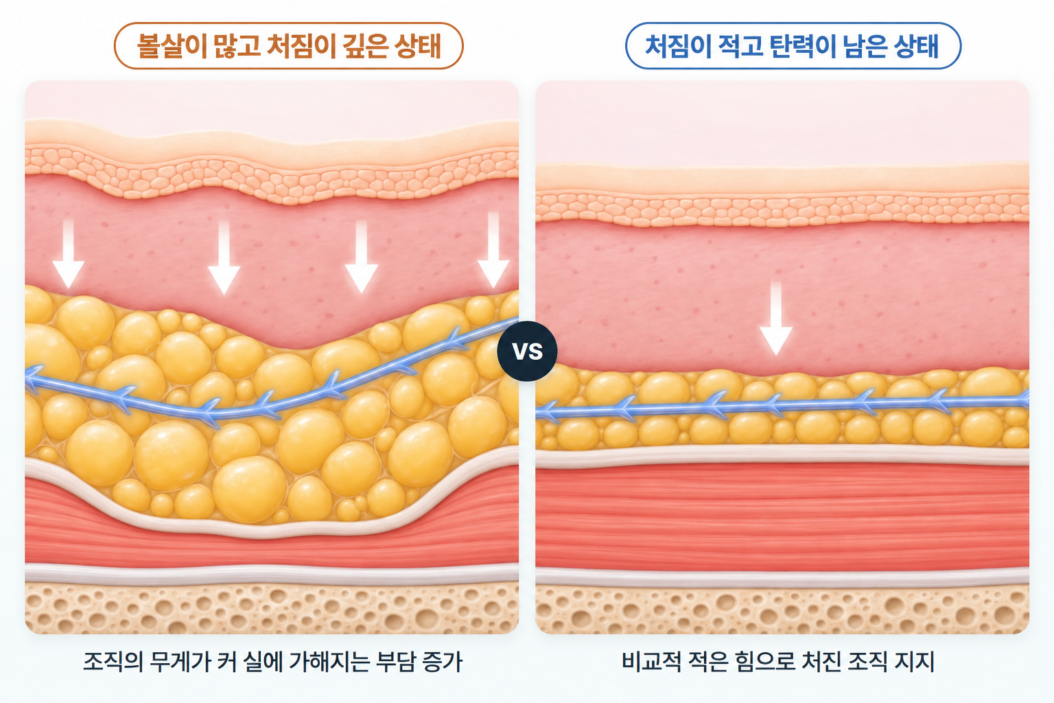 실리프팅 유지기간에 영향을 주는 볼살이 많고 처짐이 깊은 조직과 탄력이 남아 처짐이 적은 조직의 무게 및 실 지지 부담 차이