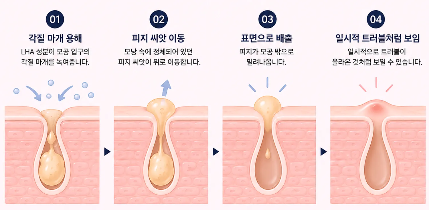 라라필 시술 후 피지가 표면으로 올라오는 과정 단계별 설명