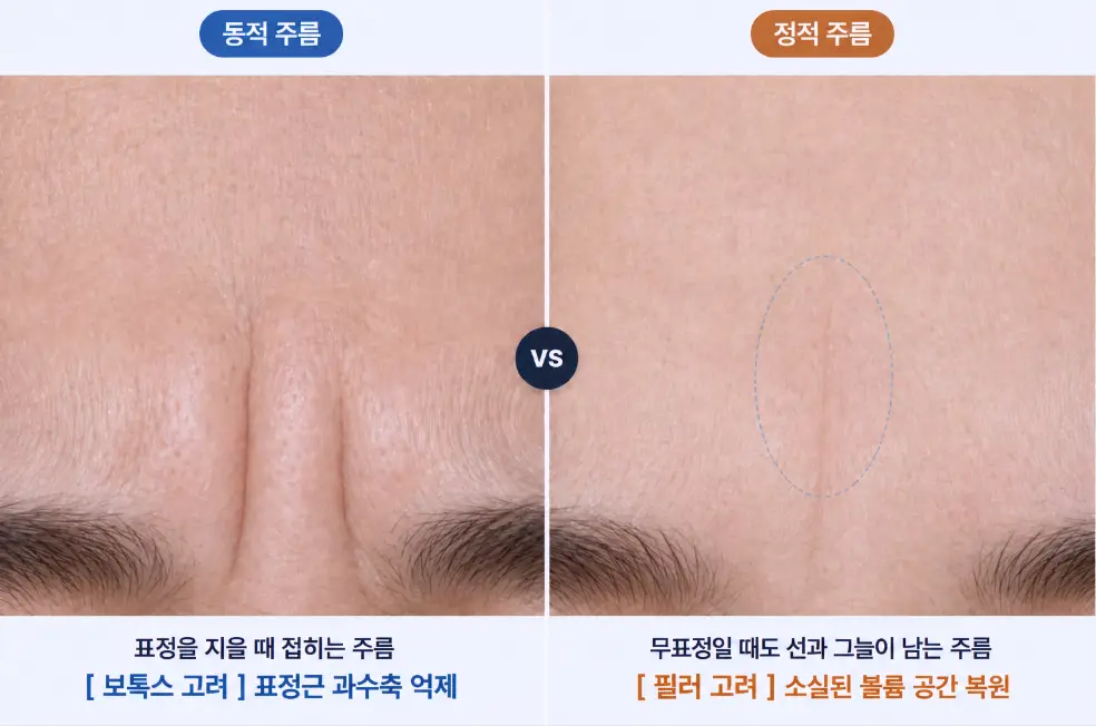 표정 시 접히는 동적 주름과 무표정 정적 주름의 보톡스 필러 선택 기준 비교