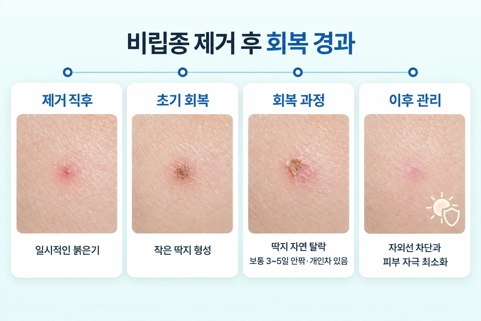 비립종 제거 직후 붉은기부터 작은 딱지 형성, 약 3~5일 전후 딱지 탈락과 피부 자국 회복까지의 변화