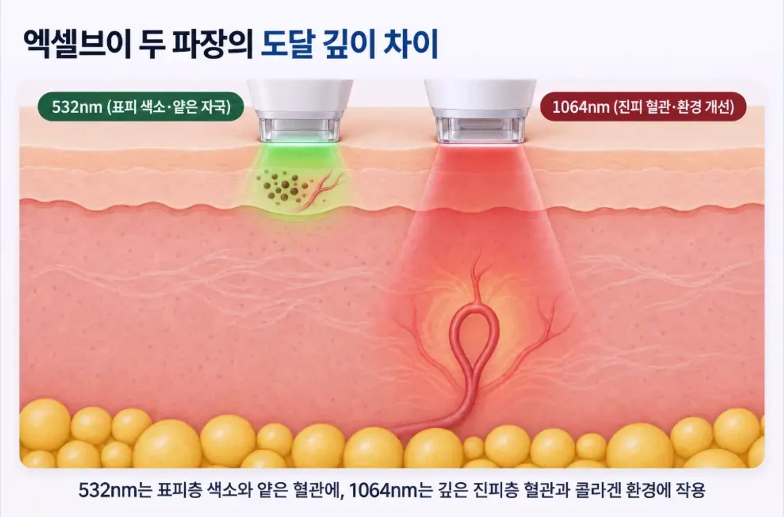 532nm 녹색광이 표피 색소, 1064nm 적외광이 진피 혈관에 도달하는 깊이를 나타낸 단면도