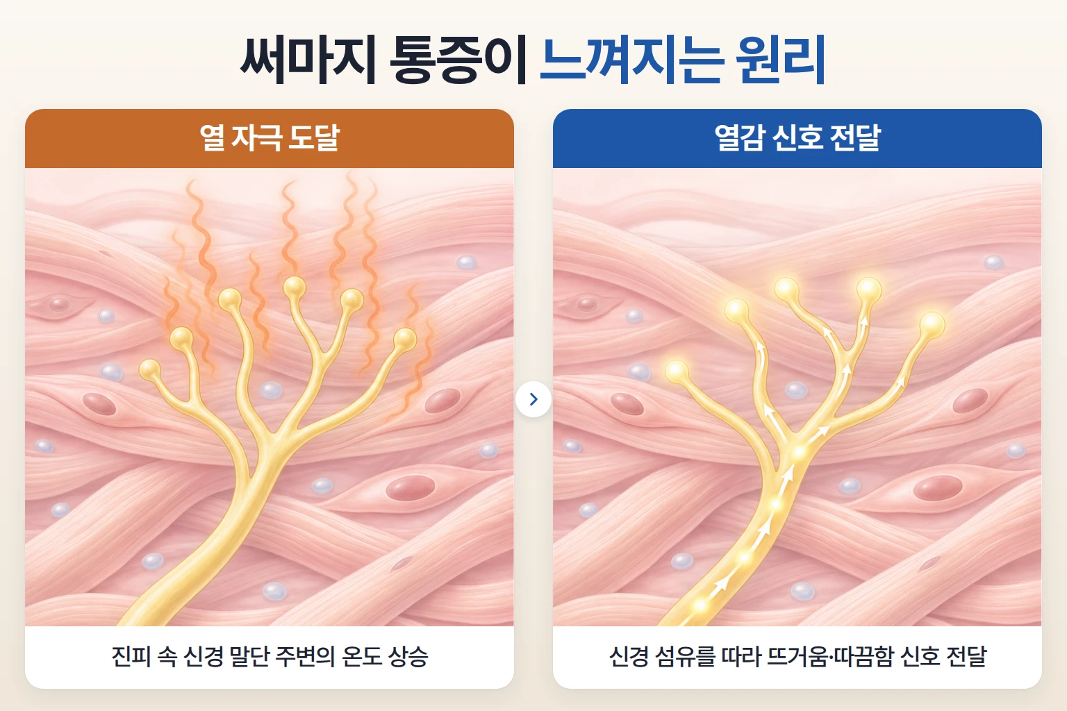 써마지 통증이 진피의 감각 신경 말단에 열 자극이 전달되며 느껴지는 과정