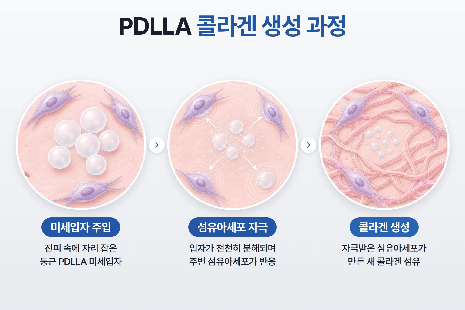 PDLLA 미세입자 분해, 섬유아세포 자극, 새 콜라겐 섬유 형성을 단계별로 나타낸 작용 개념도