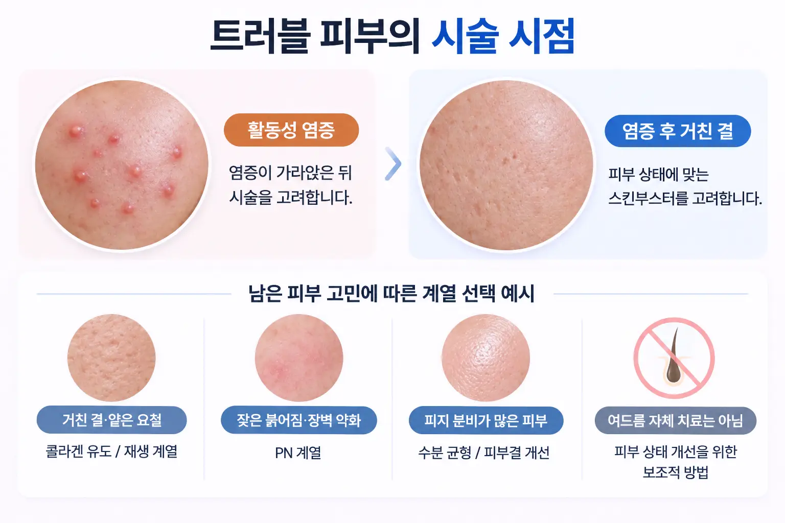 트러블 피부 스킨부스터 시술 시점 안내 이미지. 활동성 염증 여드름과 염증 후 거친 피부결을 비교하고, 피부 상태에 따른 콜라겐 유도 및 PN 계열 스킨부스터 선택 기준을 설명한 의료 인포그래픽