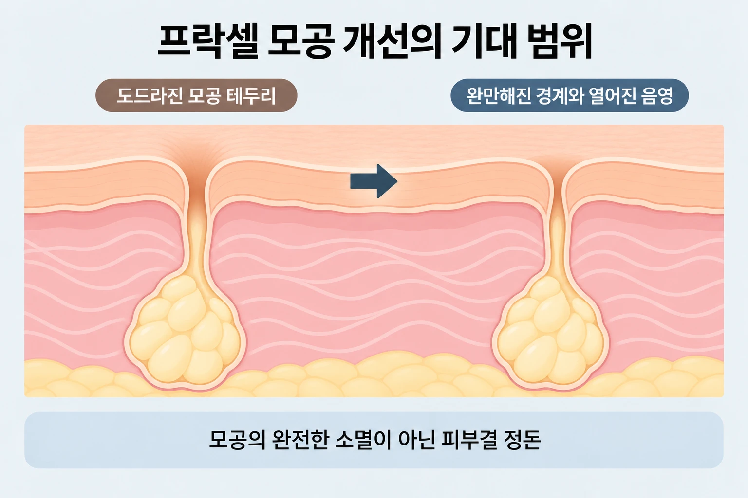 모공 구멍은 남아 있고 테두리의 단차와 음영이 완만해지는 피부 단면 비교