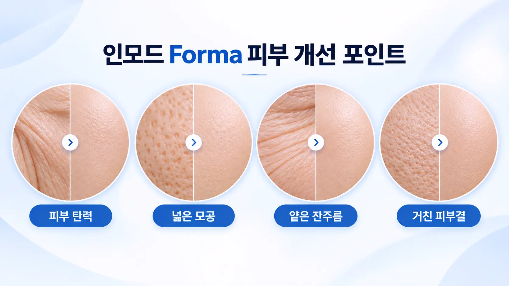 인모드 포마(Forma) 고주파 리프팅의 피부 개선 포인트를 보여주는 비교 일러스트. 피부 탄력 개선, 늘어진 모공 완화, 얕은 잔주름 감소, 거친 피부결 개선을 4가지 피부 확대 이미지로 표현