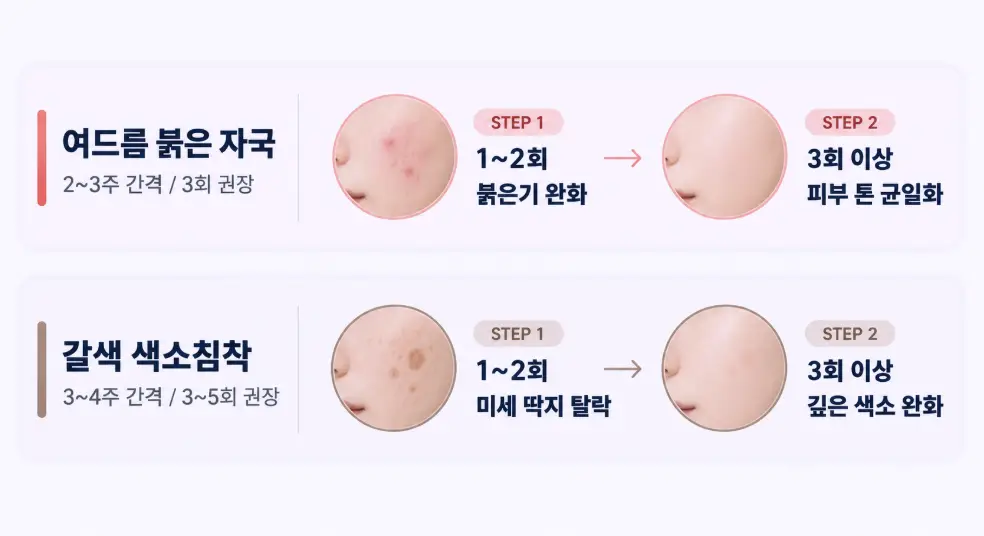 여드름 붉은 자국과 갈색 색소침착에 따른 엑셀브이 권장 시술 간격과 1~2회차 및 3회 이상 시술 후 회차별 피부 개선 과정을 정리한 타임라인