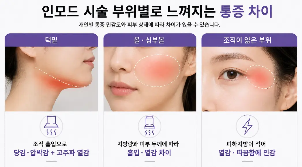턱밑·볼·심부볼 등 인모드 시술 부위에 따라 달라지는 통증 차이