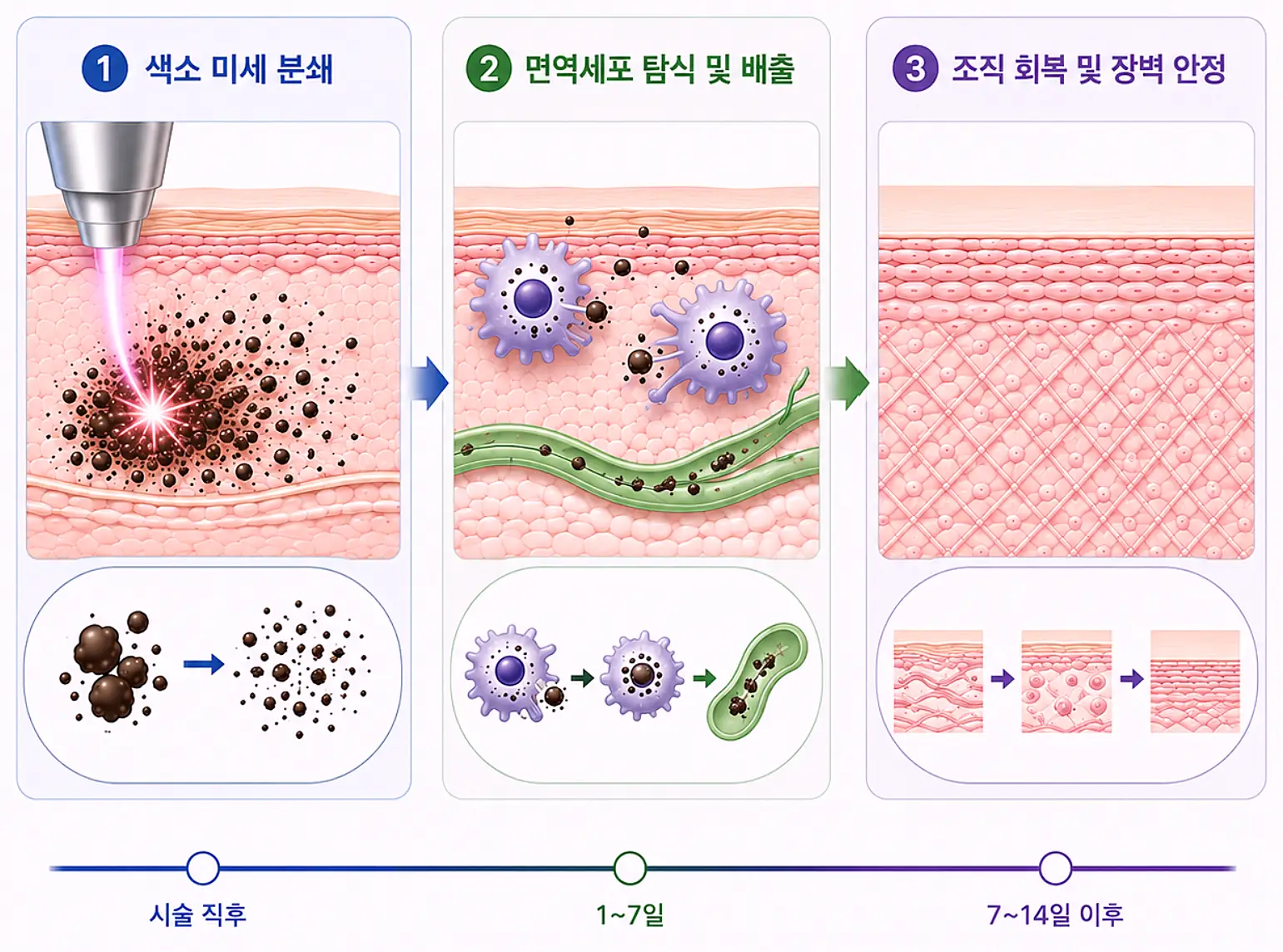 피코토닝 색소 분해와 배출 과정 - 간격이 필요한 이유