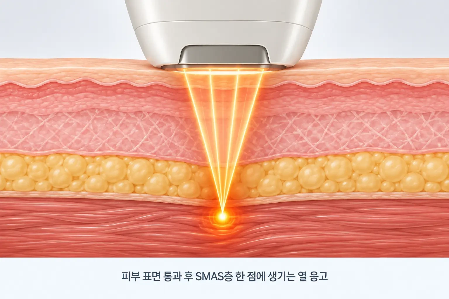 고강도 집속 초음파가 피부 표면을 지나 SMAS층 한 점에 모여 열 응고점을 만드는 원리 개념도