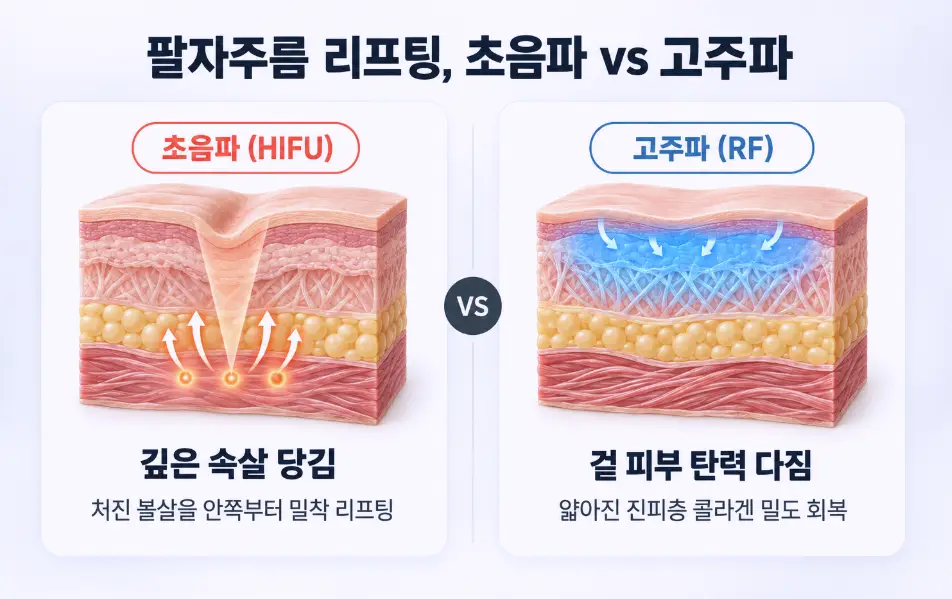 깊은 근막층 속살을 끌어올리는 초음파(HIFU) 리프팅과 진피층 콜라겐 탄력을 채우는 고주파(RF) 리프팅의 작용 깊이 비교