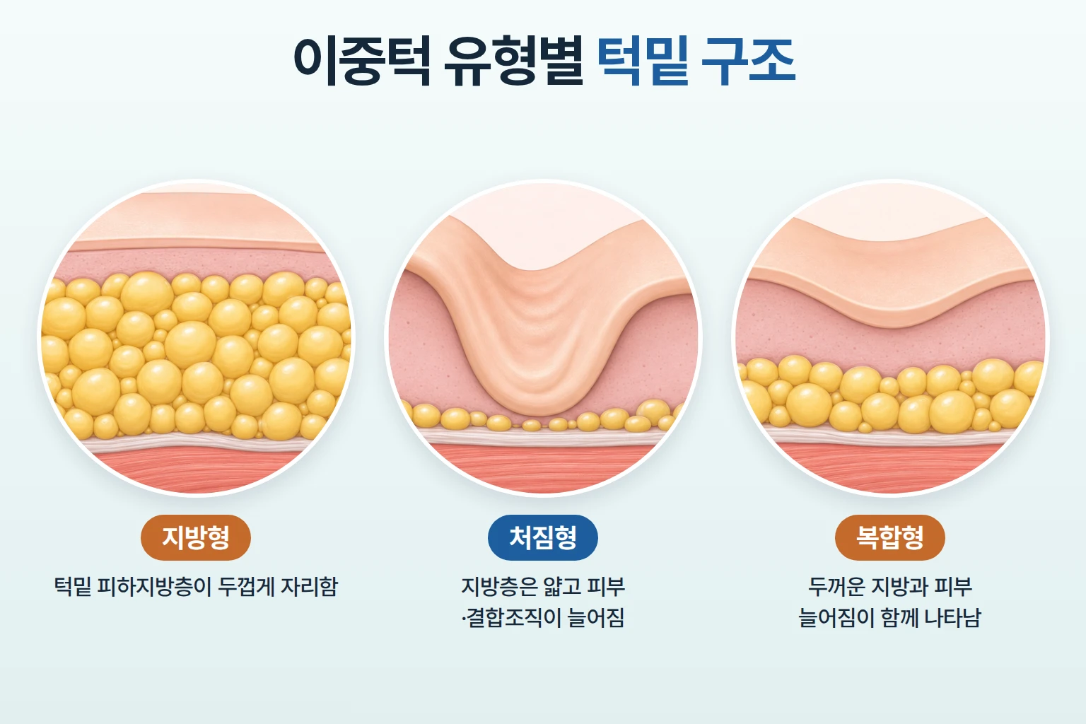 지방형, 처짐형, 복합형 이중턱의 턱밑 피하지방 두께와 피부 늘어짐을 동일 배율로 비교한 단면도