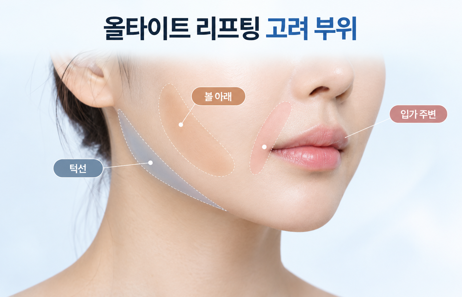 올타이트 리프팅을 고려하는 볼 아래와 턱선, 입가 주변의 피부 부위
