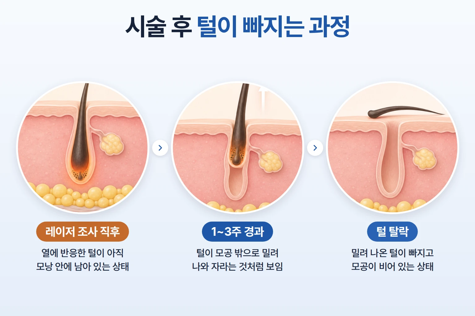 레이저제모 직후 모낭에 남은 털이 1~3주에 걸쳐 피부 밖으로 밀려 나와 탈락하는 과정