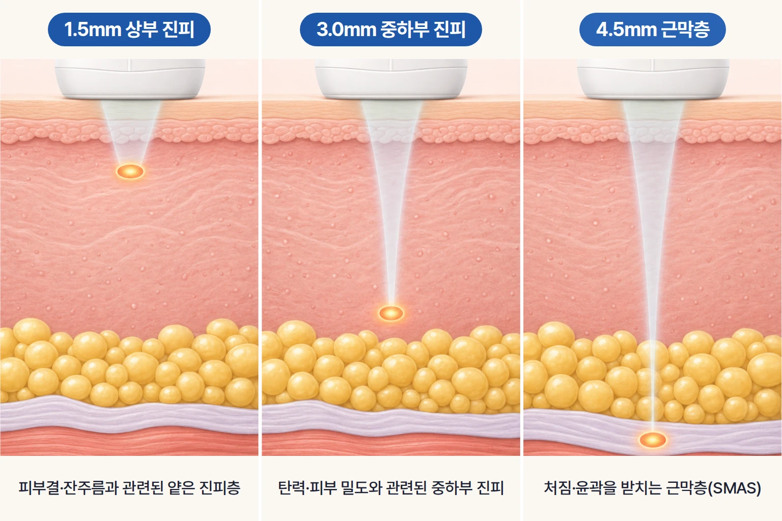 울쎄라 1.5mm, 3.0mm, 4.5mm 깊이별 열응고점이 진피와 근막층에 맺히는 위치를 비교한 단면도