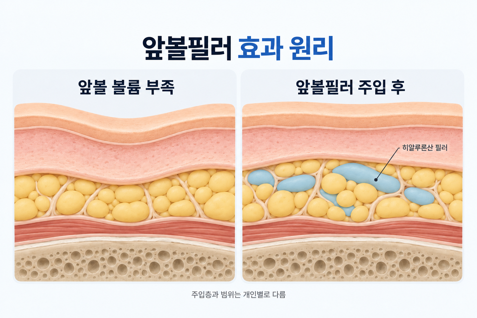 히알루론산 필러로 꺼진 앞볼의 부족한 볼륨을 보완하는 원리를 나타낸 피부 단면도