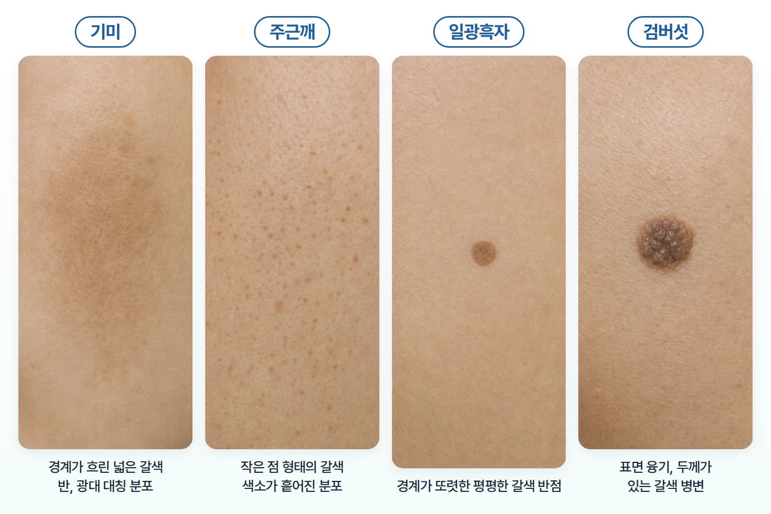 넓고 경계가 흐린 기미, 작은 갈색 점 형태의 주근깨, 경계가 뚜렷한 일광흑자, 표면이 도톰하게 올라온 검버섯의 피부 특징 비교