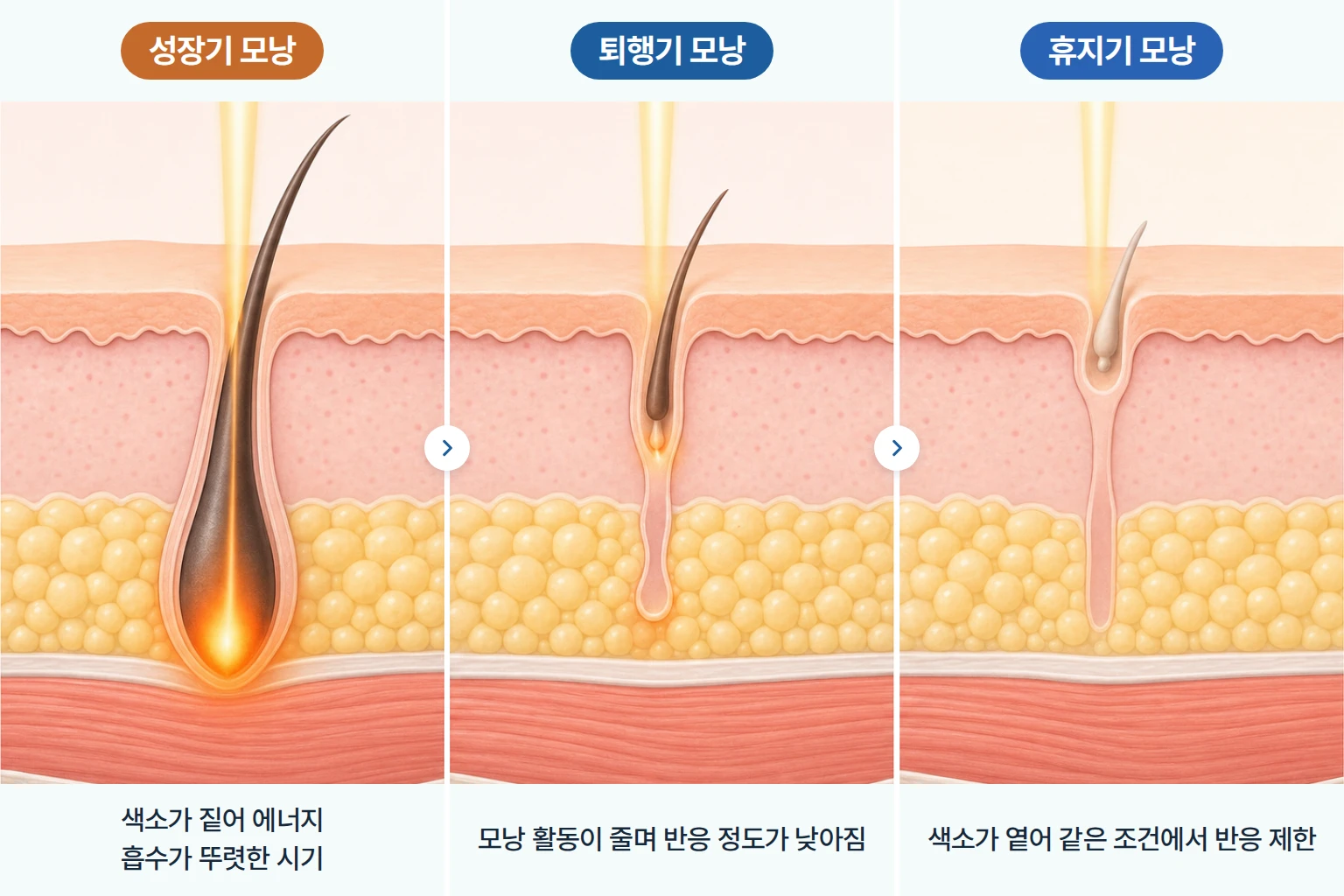 성장기, 퇴행기, 휴지기 모낭에 레이저 에너지가 흡수되는 정도를 비교한 모낭 단면 일러스트