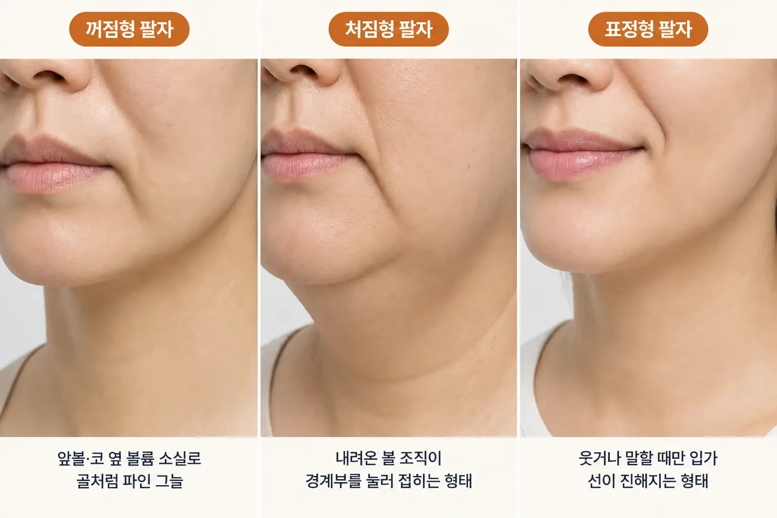 앞볼 볼륨이 줄어든 꺼짐형, 볼 조직이 내려온 처짐형, 표정형 팔자의 하관 윤곽을 비교한 사진