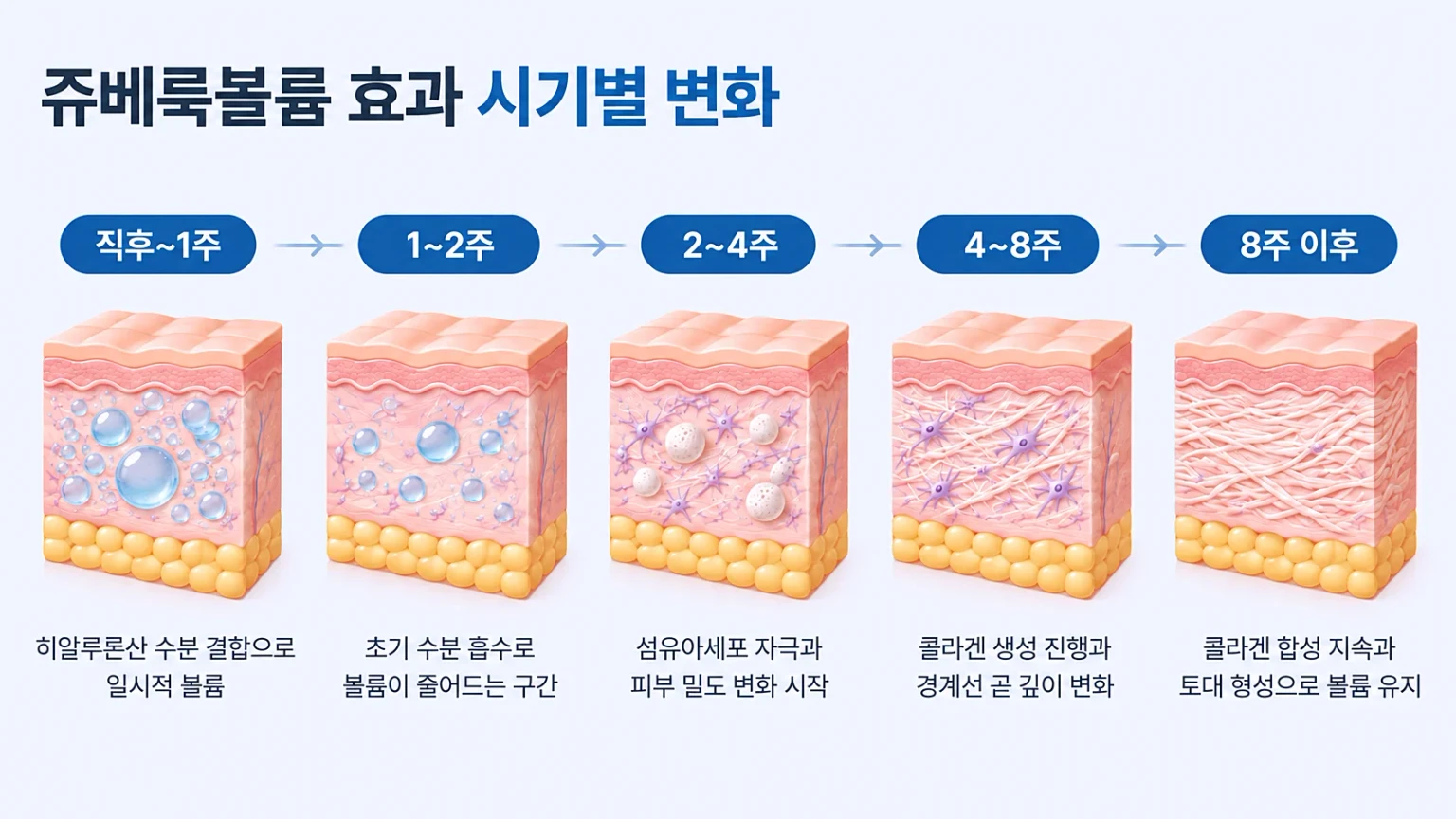 쥬베룩볼륨 주입 후 수분 볼륨 감소와 콜라겐 형성까지 시기별 변화를 정리한 타임라인