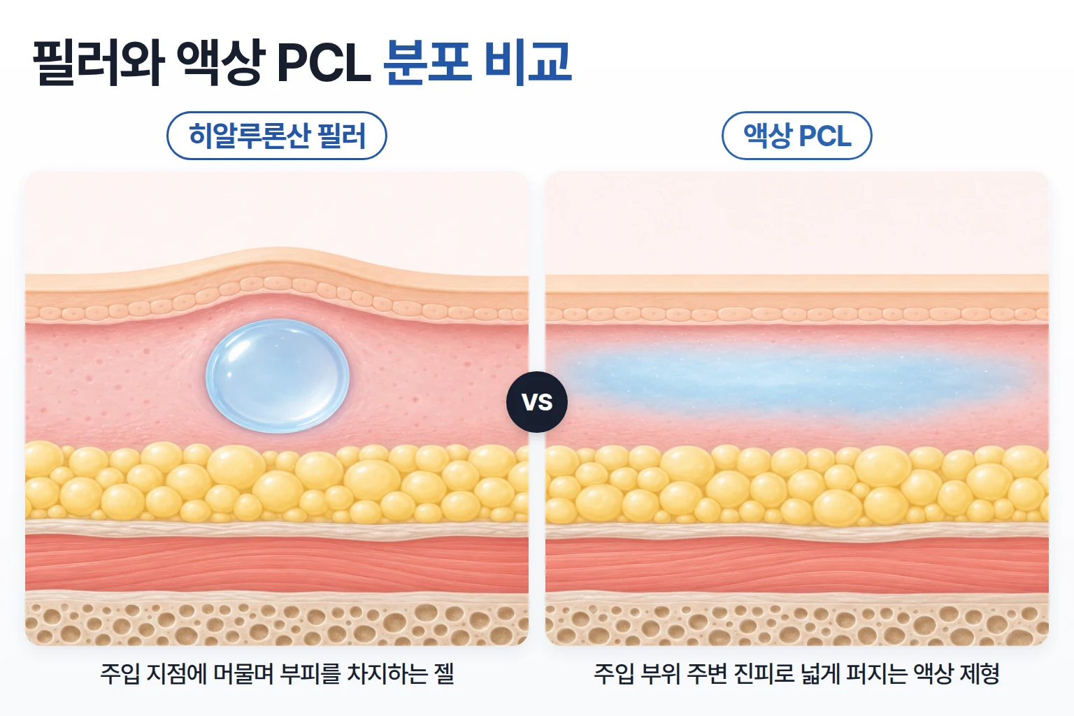 한 지점에 머무는 필러 젤과 진피에 넓게 퍼진 액상 PCL을 나란히 비교한 피부 단면 일러스트