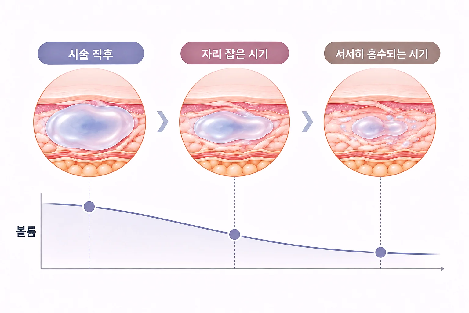 입술 필러 유지 기간 동안 히알루론산 볼륨이 서서히 줄어드는 흐름 다이어그램