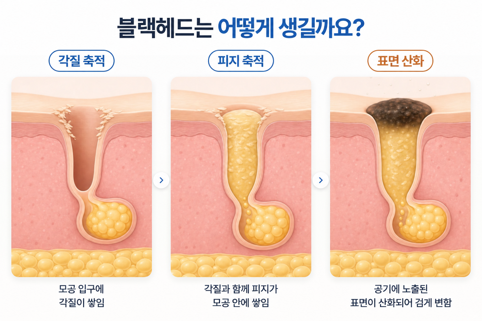 블랙헤드 발생 원인인 모공 입구의 각질 축적, 피지 축적, 표면 산화에 따른 검은 면포 형성 과정