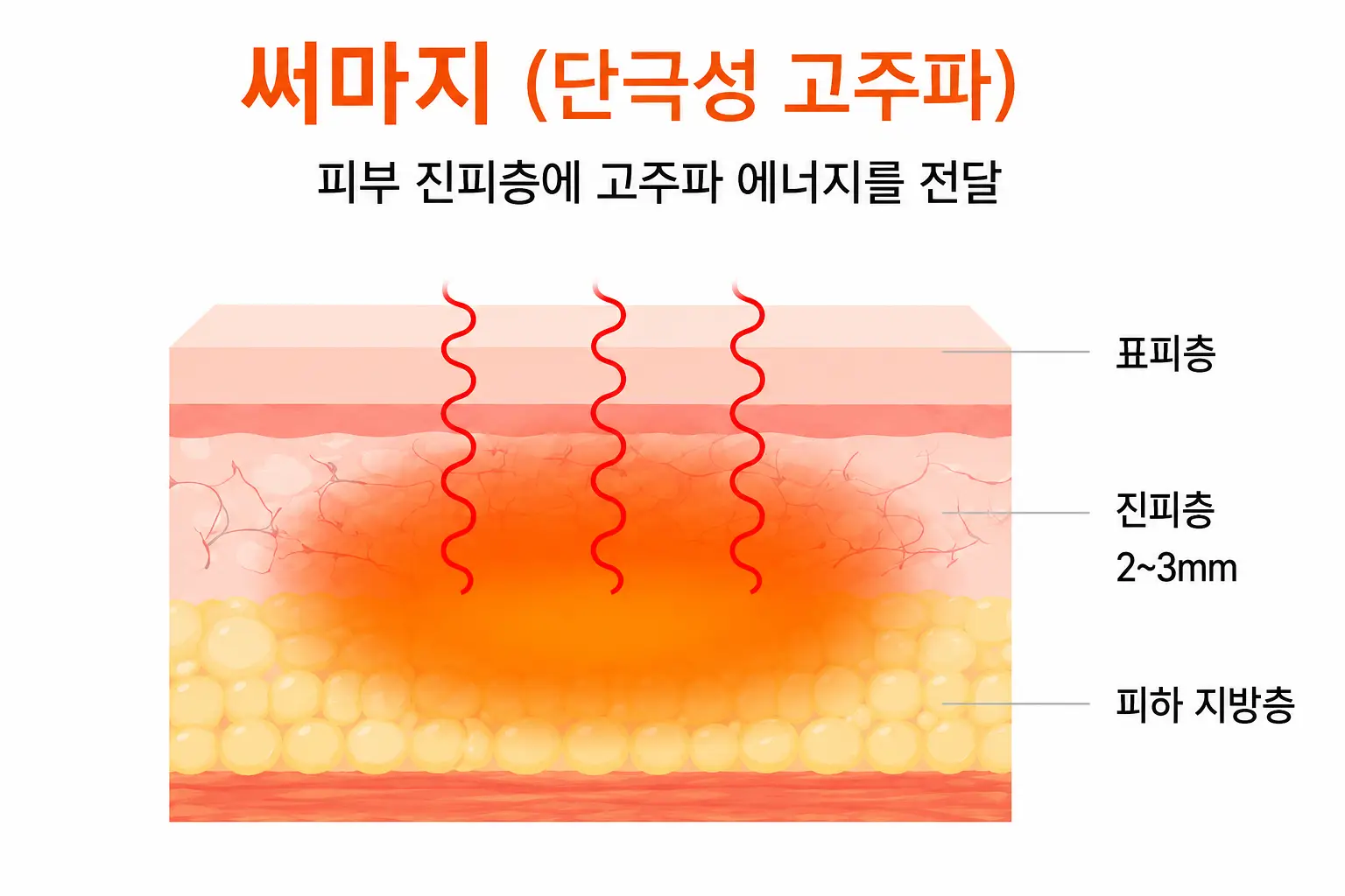 울쎄라 써마지 중 써마지 효과를 만드는 고주파 작용 원리