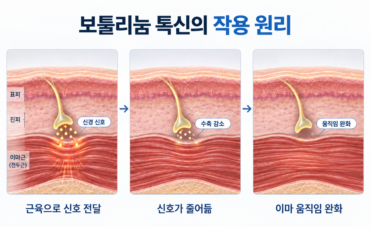 신경 신호 감소와 전두근 수축 완화를 통한 보툴리눔 톡신 작용 원리