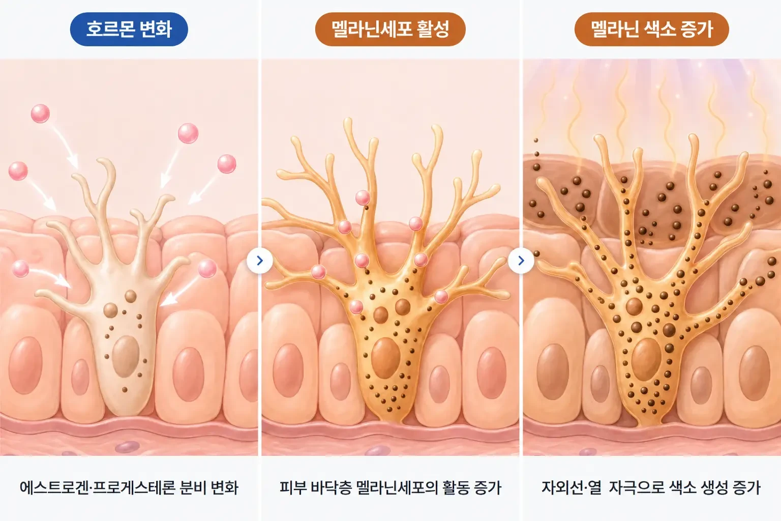 임신 중 호르몬 변화, 멜라닌세포 자극, 멜라닌 색소 증가 과정을 단계별로 나타낸 개념도