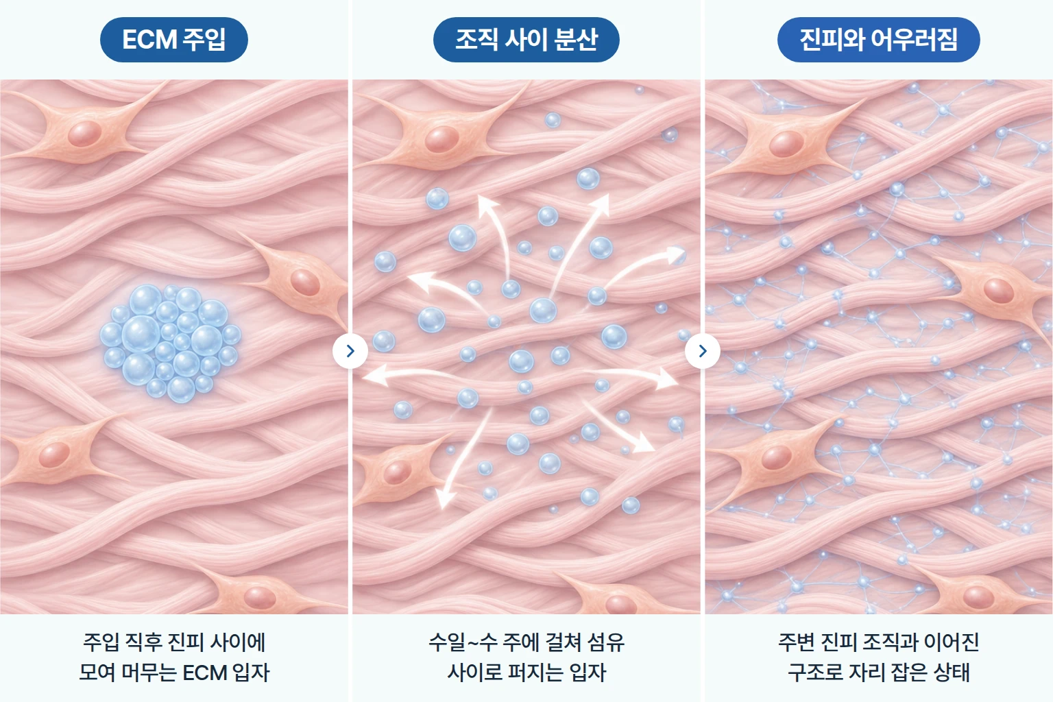 리투오 ECM 입자가 진피 콜라겐 섬유 사이로 퍼져 자리 잡는 과정을 단계별로 나타낸 개념도