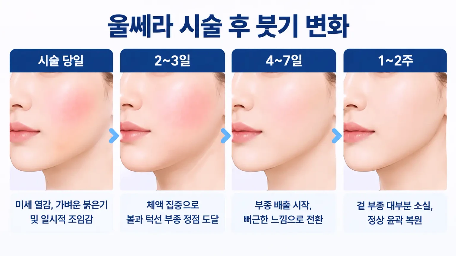 울쎄라 후 붓기 변화 과정을 시술 당일, 1~3일, 4~7일, 1~2주로 나누어 볼과 턱선의 붓기 및