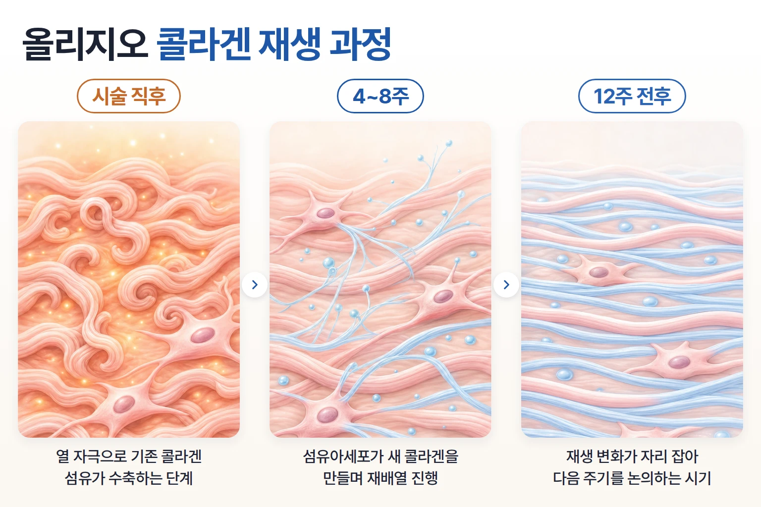 시술 직후 수축한 콜라겐 섬유가 12주에 걸쳐 새 섬유로 재배열되는 과정을 단계별로 나타낸 개념도