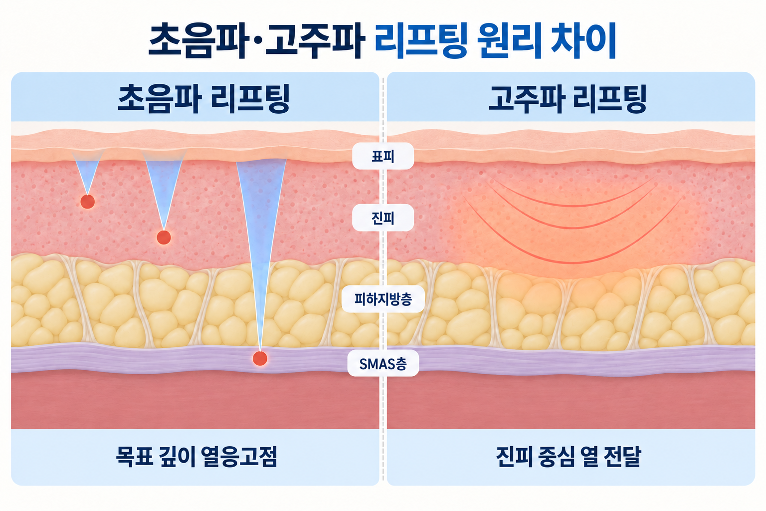 불독살 개선을 위한 초음파 리프팅과 고주파 리프팅의 에너지 전달 깊이 및 작용 원리를 비교한 피부 단면도