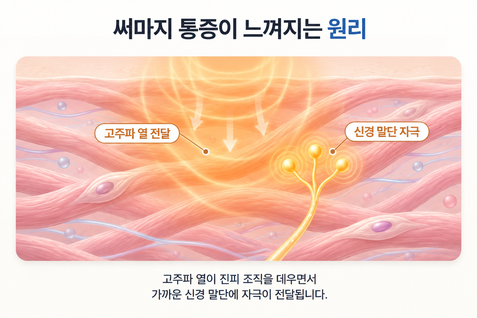 써마지 통증이 발생하는 고주파 열 전달과 진피 조직 내 신경 말단 자극 원리
