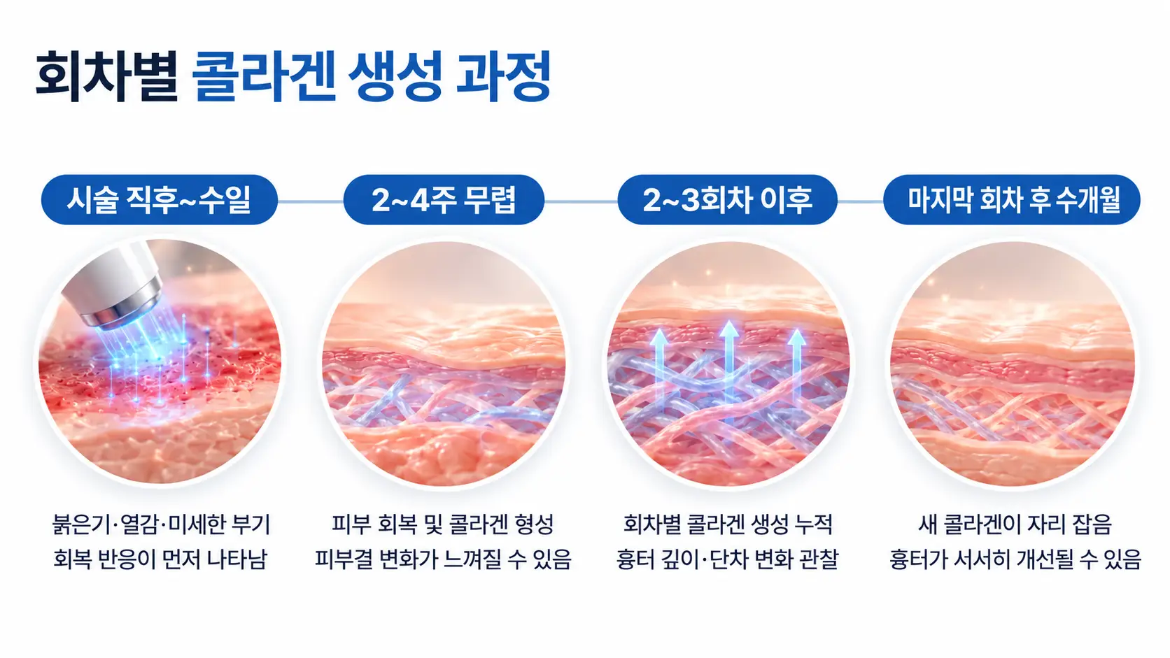시술 직후부터 마지막 회차 후까지 콜라겐 누적과 흉터 단차 변화를 시기별로 정리한 경과 흐름