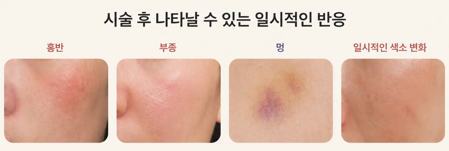 여드름 흉터 치료 후 나타날 수 있는 일시적인 피부 반응