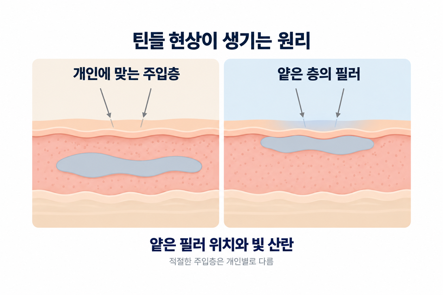 눈밑필러를 얕은 피부층에 주입했을 때 필러가 푸르스름하게 비쳐 보이는 틴들 현상의 원리를 설명한 피부 단면도